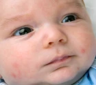 Potravinové alergie spolu s ekzémem kradou dětem kila i centimetry 
