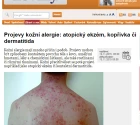 Projevy kožní alergie: atopický ekzém, kopřivka či dermatitida