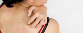 Projevy kožní alergie: atopický ekzém, kopřivka či dermatitida